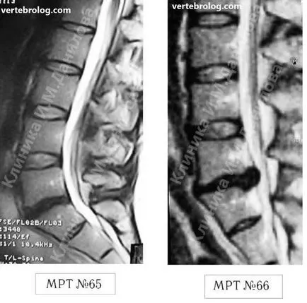 гръбначния сцепление провокира херния