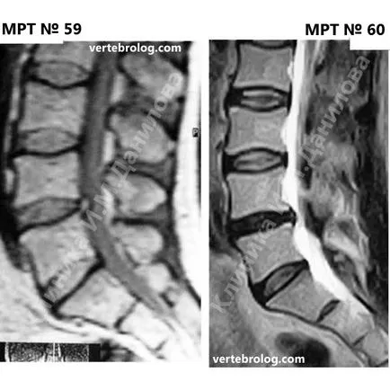 гръбначния сцепление провокира херния