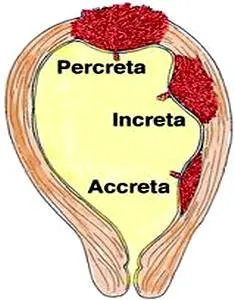 Încarnarea a placentei în rumen, placenta