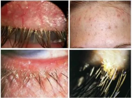 Krónikus blepharitis osnovyne tünetek és kezelés