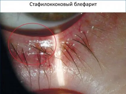 Krónikus blepharitis osnovyne tünetek és kezelés