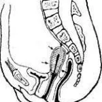 Bend patologia de col uterin, care este, cauze, tratament