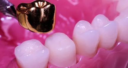 coroane de aur - beneficii de producție și prețul de coroane dentare din aur