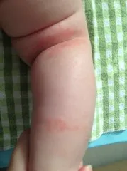 Alergic la ulei de măsline într-un copil - alergii copii