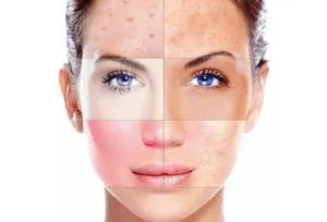 Allergia bőr - kezelések
