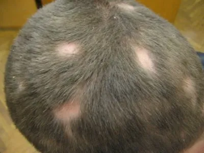 Alopecia areata este un copil care alopecie chelie și care sunt cauzele copiilor