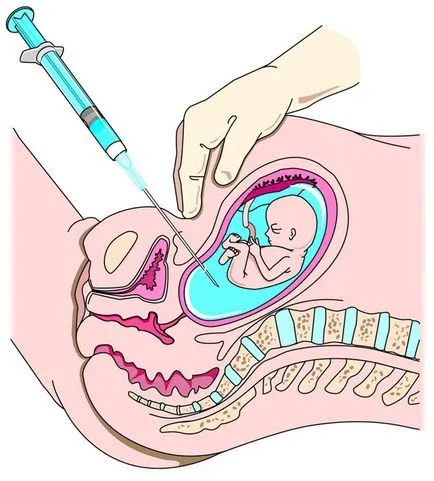 Amniocentesis előkészítése és lebonyolítása, amikor kinevezték, lehetséges szövődmények