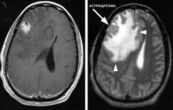 Brain Astrocitomul - ce este, cât de periculos poartă tumoare