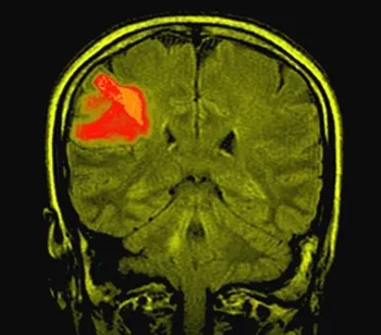 agyi astrocytoma kezelés, prognózis, a következmények