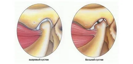 Osteoarthritis az állkapocsízület tünetek és a kezelés