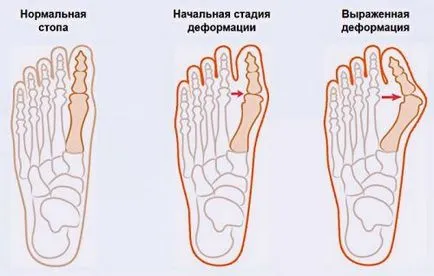 Остеоартритът на големия пръст на крака лечения за заболявания