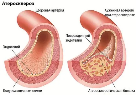 Atherosclerosis brachiocephalic artériák tünetek