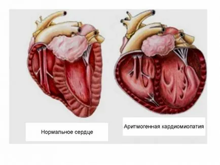 Cardiomiopatia aritmogenica (akmp)