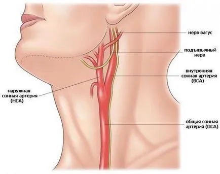 Атеросклерозата на brachiocephalic артерии - Видове, причини, симптоми, диагностика и лечение
