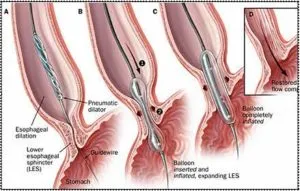 Achalasia szakaszban, a tünetek, a kezelés