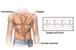 ischemie miocardică silențioasă