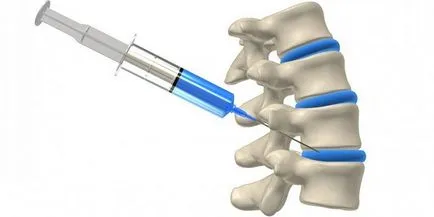 Blocada herniei coloanei vertebrale în cazul în care este periculos, cât de multe acte