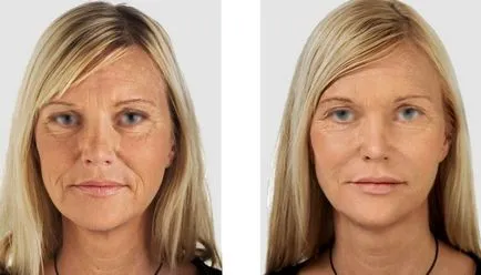 Botox vagy kseomin jobb, mi a különbség az, hogy hosszabb ideig tart