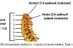 Tservikokranialgiya вертеброгенни и нейното лечение