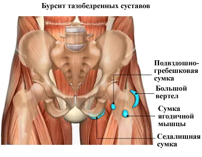 Cauze bursită, simptome, tratament