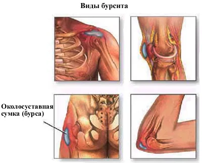 Cauze bursită, simptome, tratament