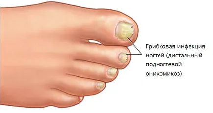 Mennyire veszélyes Nail Gombák