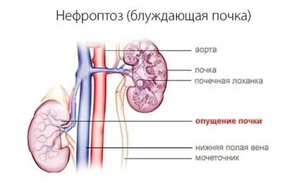 Mint kezelni a vese fáj, ha a tünetek kezelésére és népi jogorvoslati