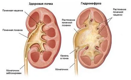 Mint kezelni a vese fáj, ha a tünetek kezelésére és népi jogorvoslati