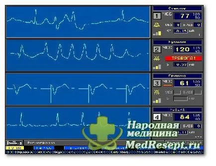 Какво заплашва аритмия - лечение на сърцето