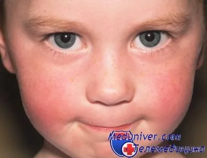 Mi a teendő, ha egy gyerek fagyott arc, fül vagy orr fagyási gyerekek