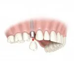 Mit kell tudni a fogászati ​​implantátumok