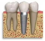 Какво трябва да знаете за зъбни импланти