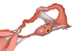 Care este obstructia trompelor uterine