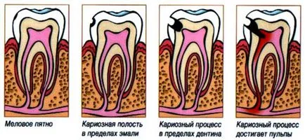Ce este cariilor dentare și cum să trateze