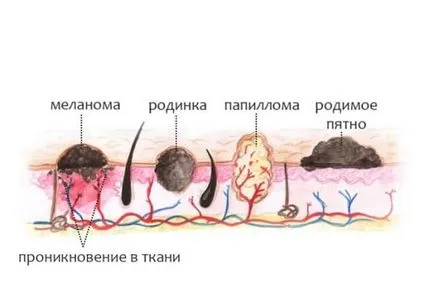 Какво е определението на брадавицата за големи и малки брадавици по тялото