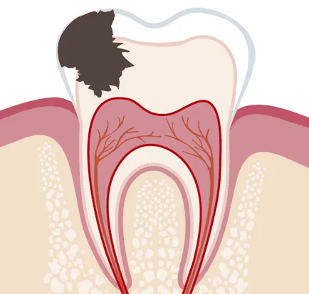 Ce este cariilor dentare și cum să trateze