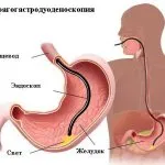 EGD, hogy felfedje a gyomorban, ami azt mutatja, gasztroszkópia