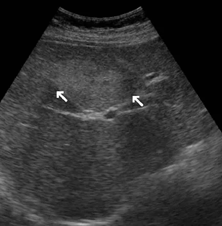 Diagnózis óriás üreges hemangioma a májban egy klinikai eset - mintegy kurzantseva