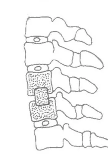 Displazic instabilitate a coloanei vertebrale cervicale