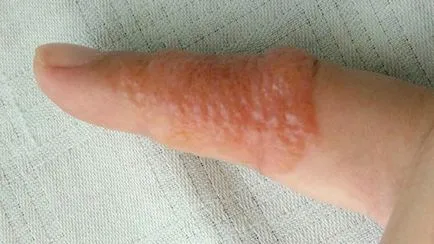 Disgidroticheskaya eczema la copii si adulti tratati si simptome toate despre alergii