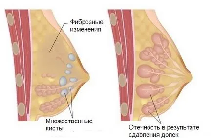 Mastopathia diffúz klinikai sajátosságait és szempontjait terápia