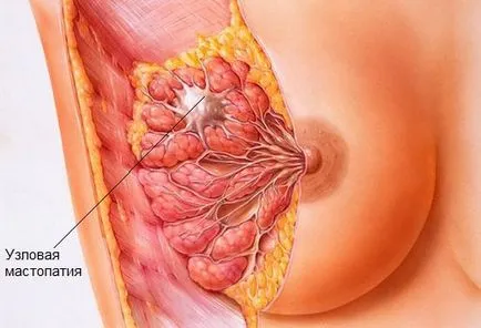 Mastopatie difuze caracteristici și aspecte clinice de terapie