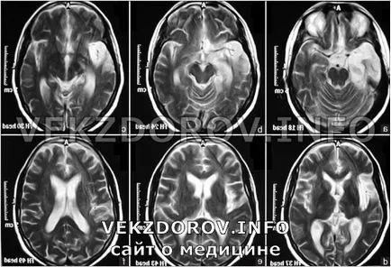 encefalopatie circulatorie cerebrală și tratamentul clinic