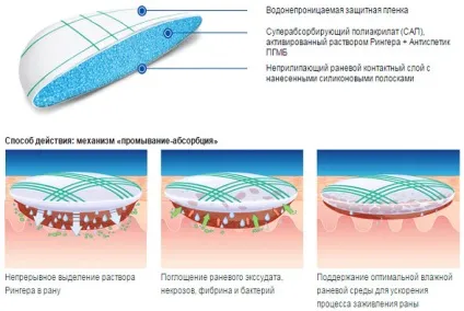 трофічні виразки