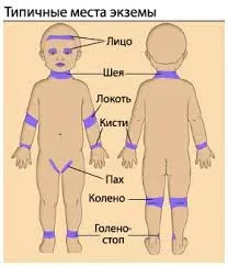 Екзема при децата предизвиква, профилактика, лечение и симптоми