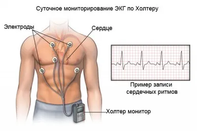 Екстрасистоли аритмия причини, симптомите и лечението