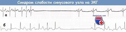EKG sick sinus szindróma (SSS)