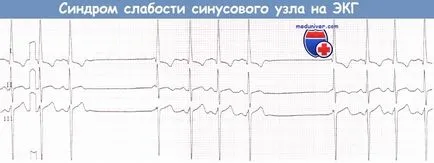 EKG sick sinus szindróma (SSS)