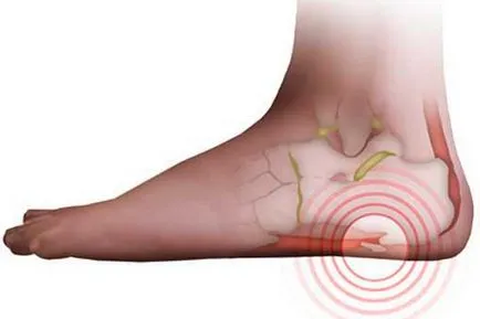 Exostosis de oase și cartilaje, piciorul, Metatarsal și osul călcâiului