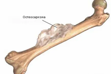 Exostosisok a csont és porc, a láb, a lábközépcsont és a sarok csont